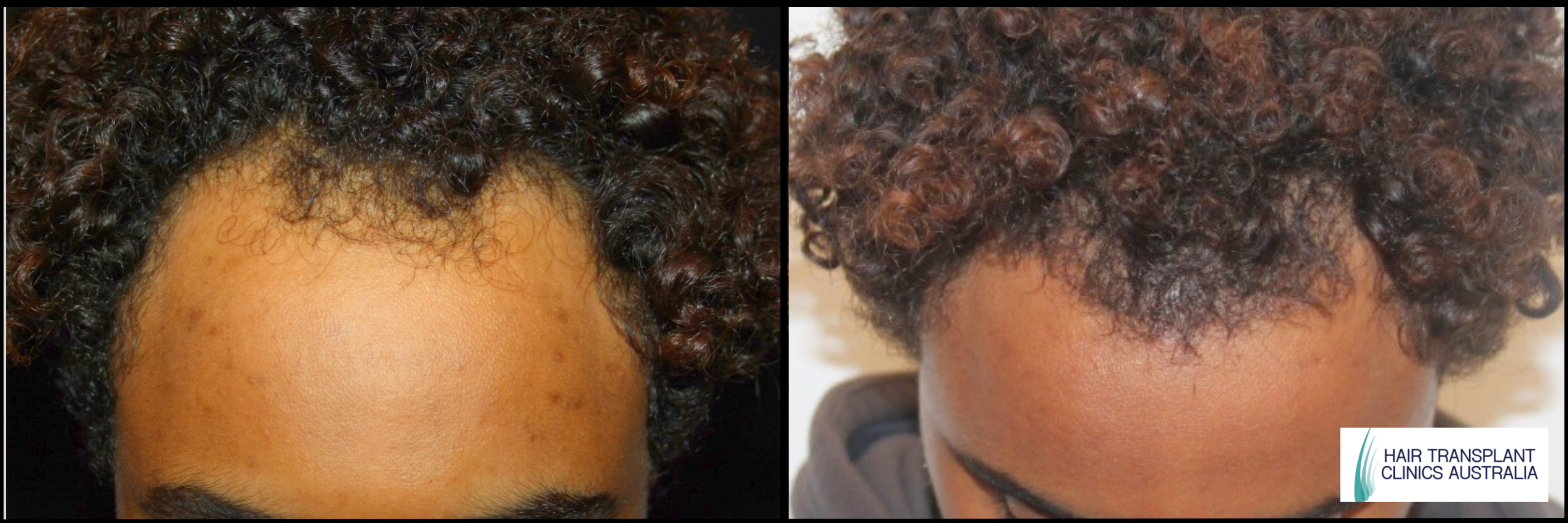 Scalp FUE Before & After Image
